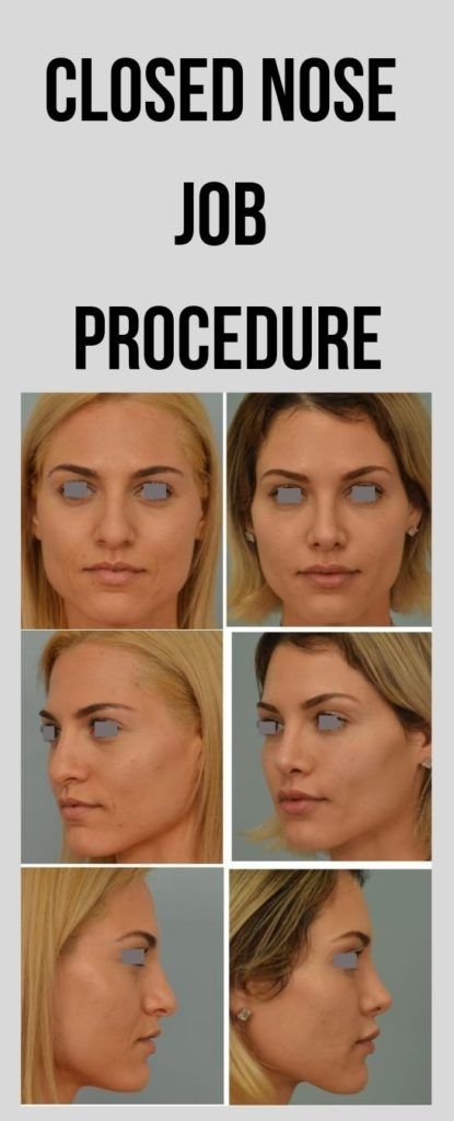 Closed rhinoplasty