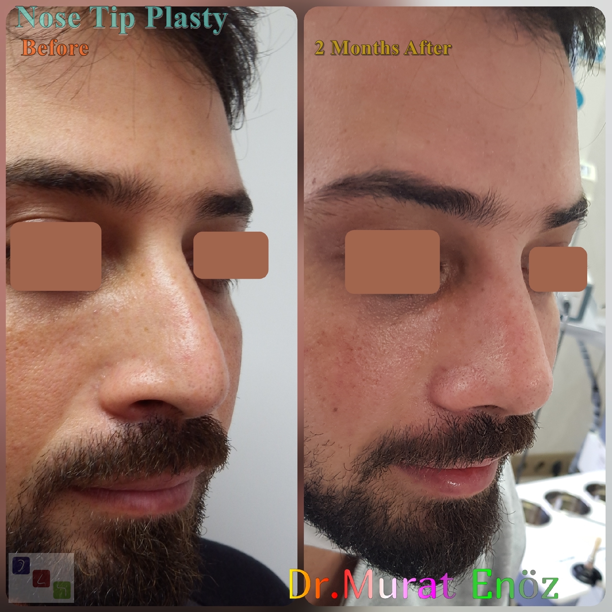 Closed rhinoplasty