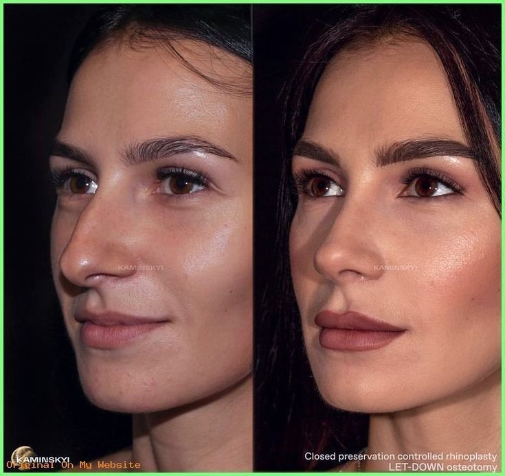 Closed rhinoplasty