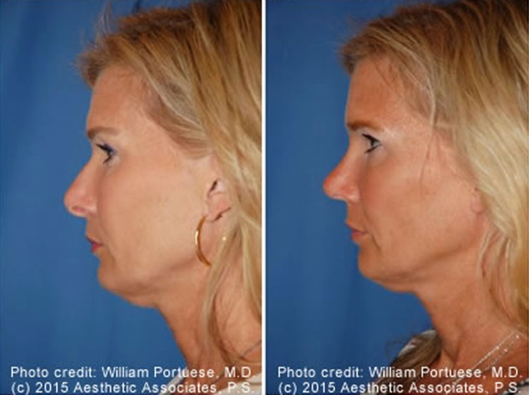 Closed rhinoplasty