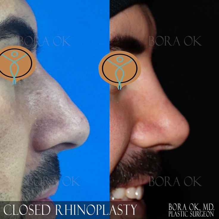 closed nose job